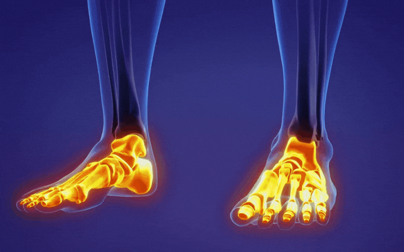 Best Orthotics to Help Posterior Tibial Tendonitis