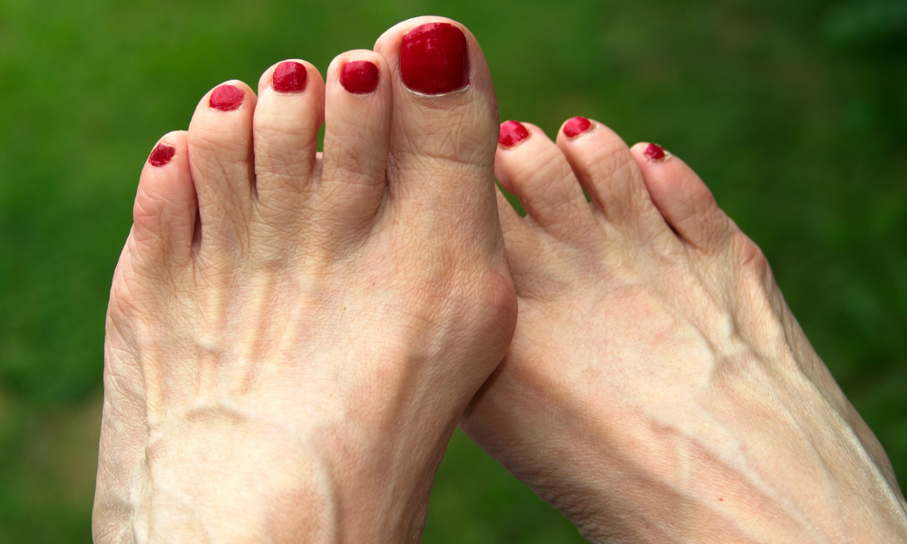 Do Bunions Splints Really Work? Effectiveness Bilt Labs