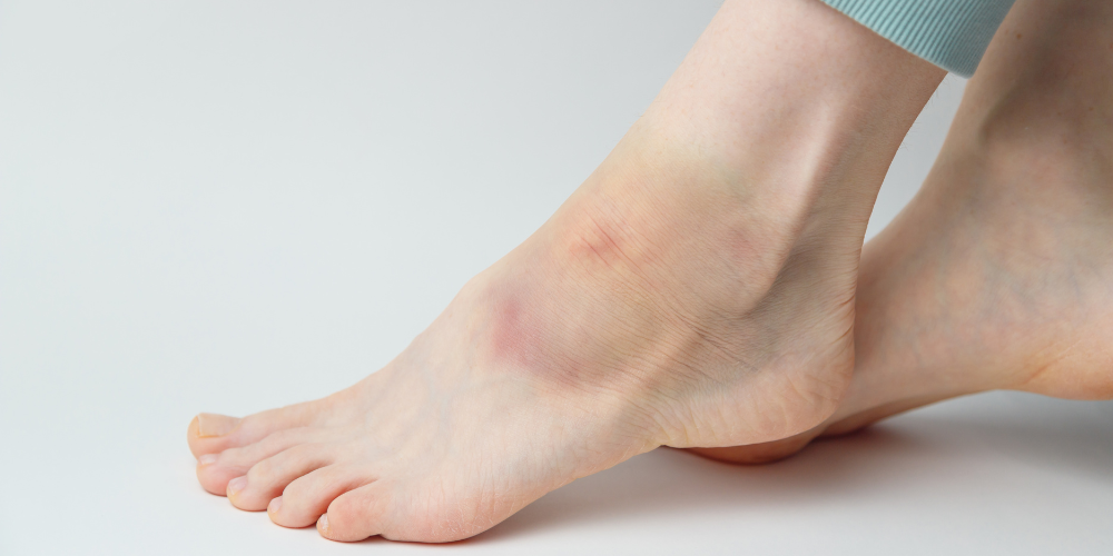 A person experiencing a stone bruise