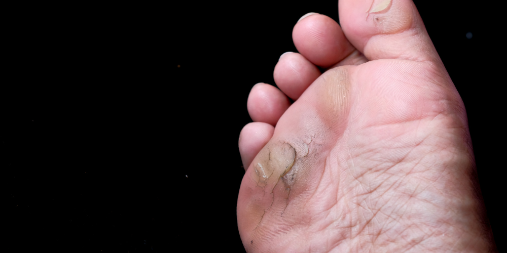 a person with athlete's foot