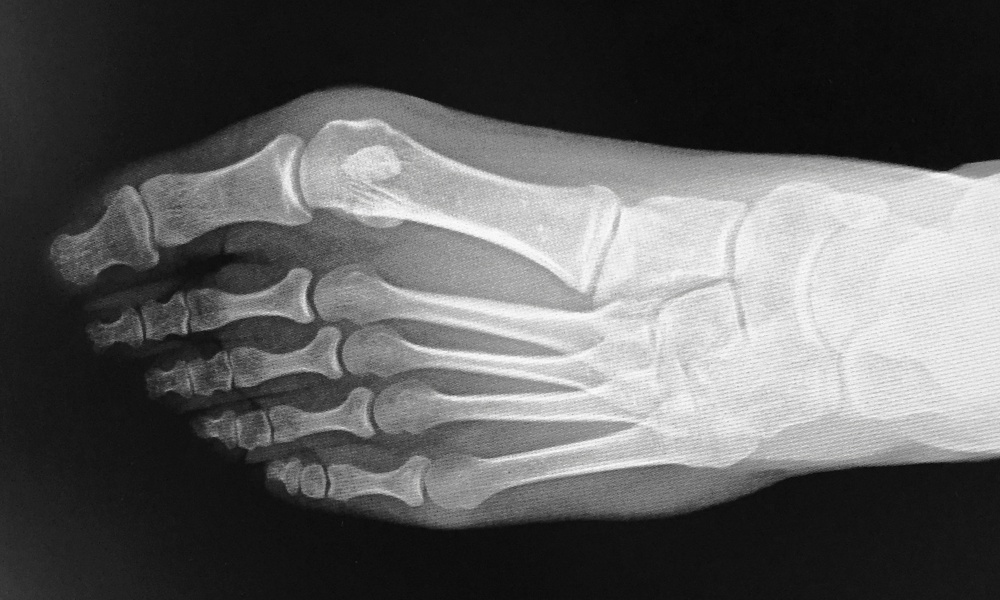 An x-ray of foot bones.