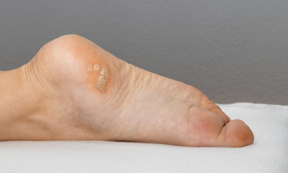 What Triggers Plantar Warts?