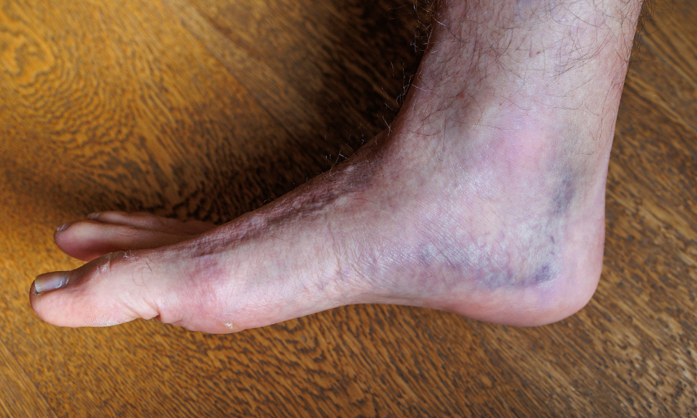 Bruised Heel: Causes, Symptoms, Treatments.