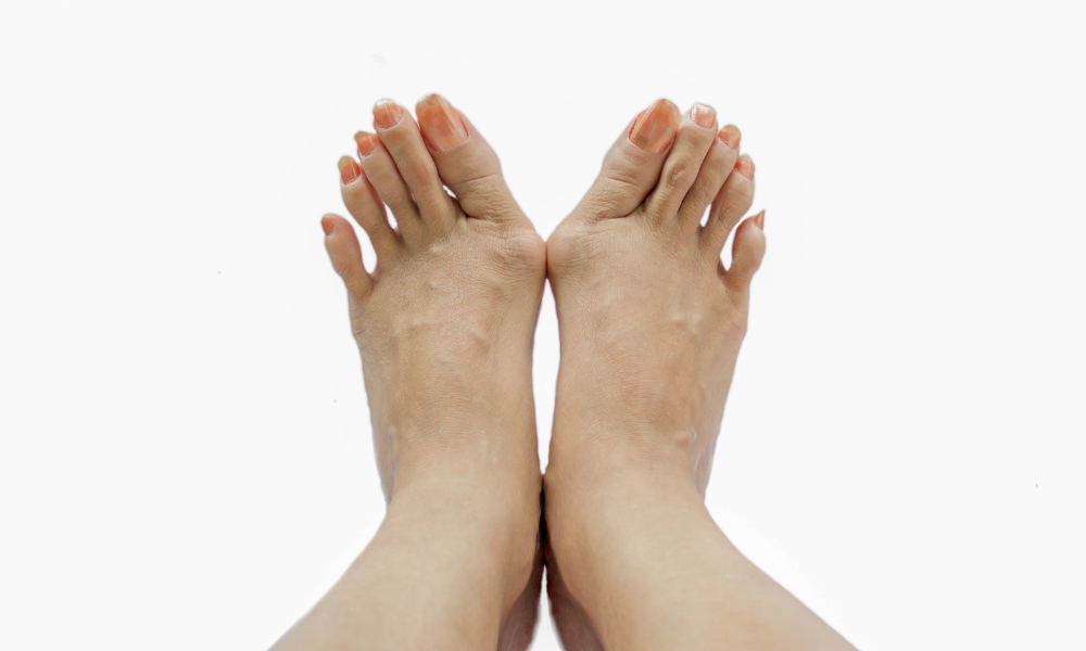 Bunions Be Gone! Treatments & Relief For Bumpy Toes.