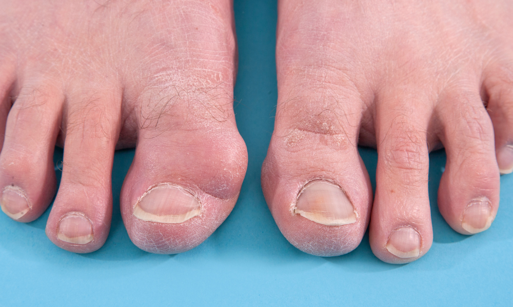 Bunions & Hammertoes: Addressing Common Toe Deformities.