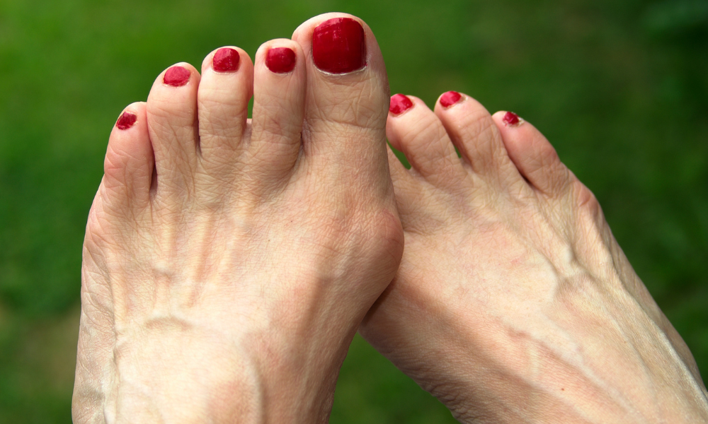 Do Bunions Splints Really Work?