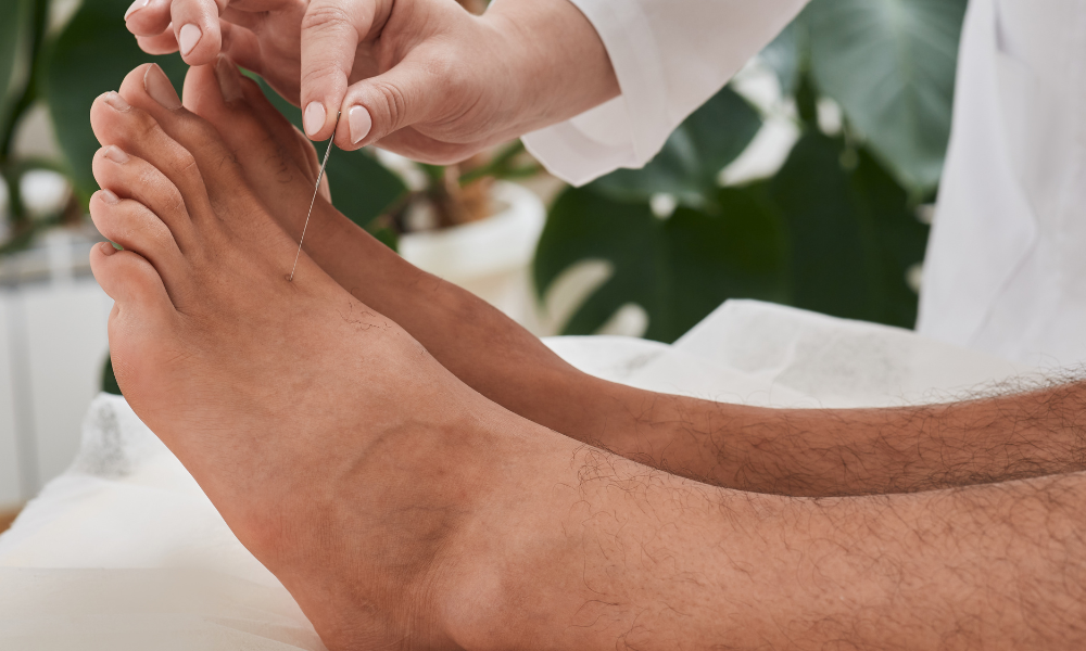 Acupuncture For Plantar Fasciitis