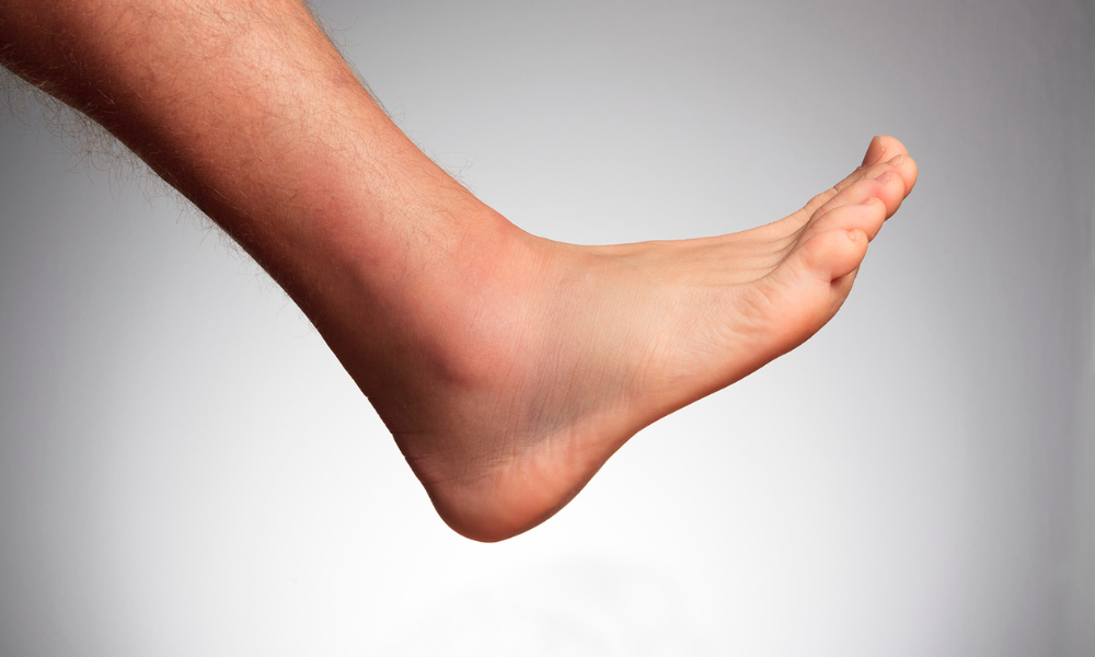 Overpronation of the foot