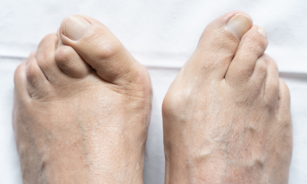 How To Help Your Hammertoe Pain? Treatment Options. – Bilt Labs