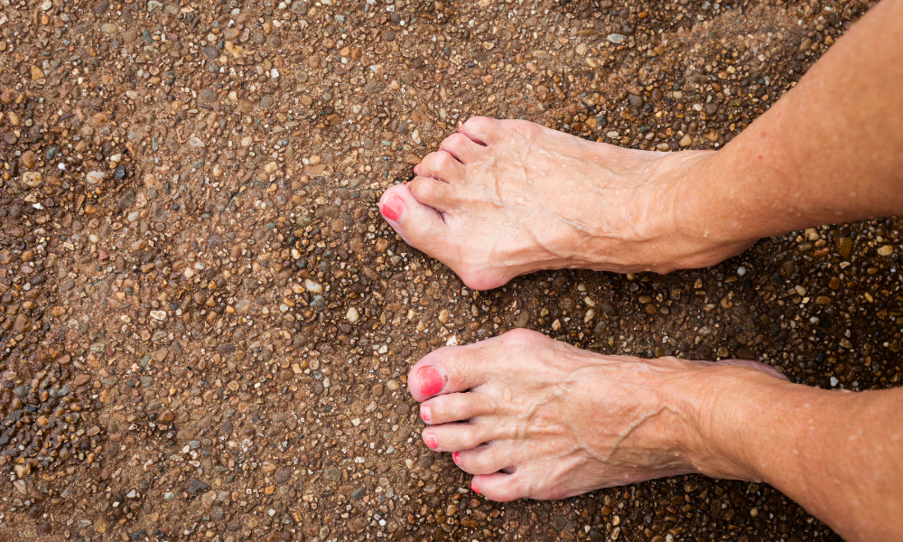 What Causes Hammer Toe?