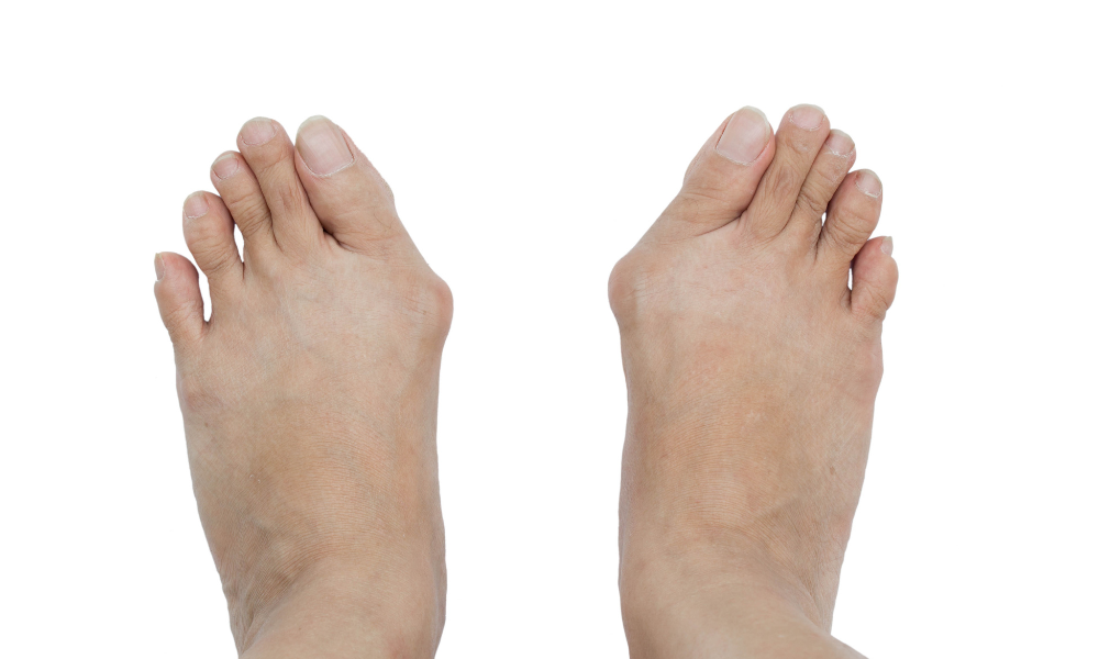 How to Help Your Bunions Without Surgery?
