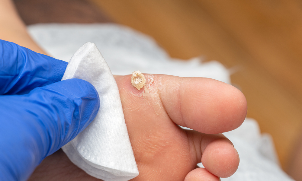 Why Do I Get Warts On My Feet?